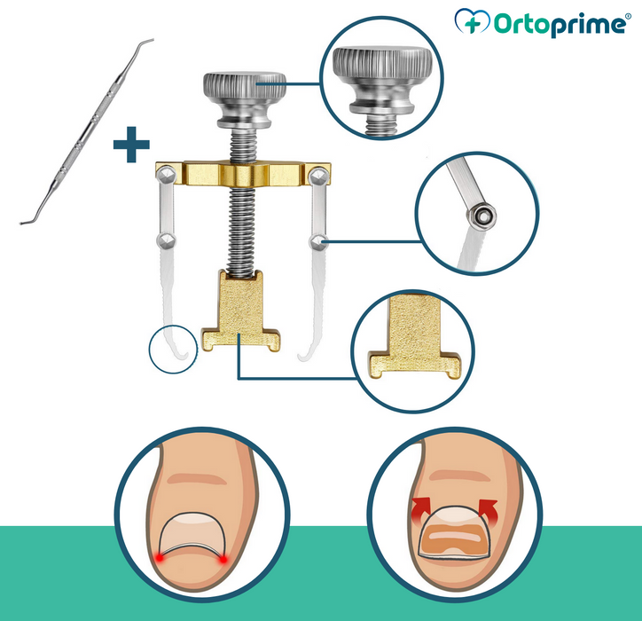 adjustable‑ingrown‑nail‑corrector‑and‑lifter‑ortoprime-uk