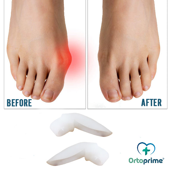 hallux-valgus-correction-toe-kit-ortoprime-uk