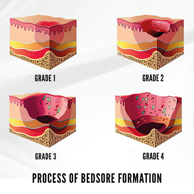 hand-relief-protection-mitts-ortoprime-uk