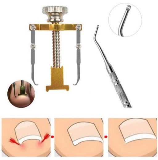 ingrown‑toenail‑correction‑kit‑stainless‑steel‑ortoprime-uk