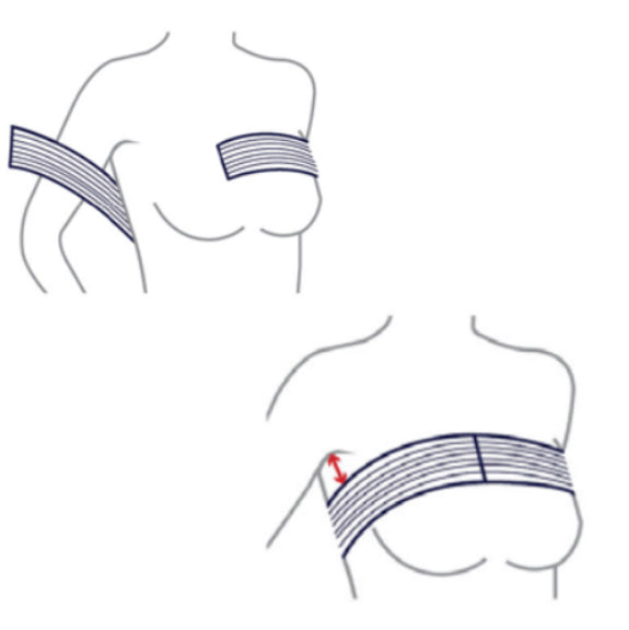 post-op-breast-compression-band-white-black-augmentation-support-ortoprime-uk